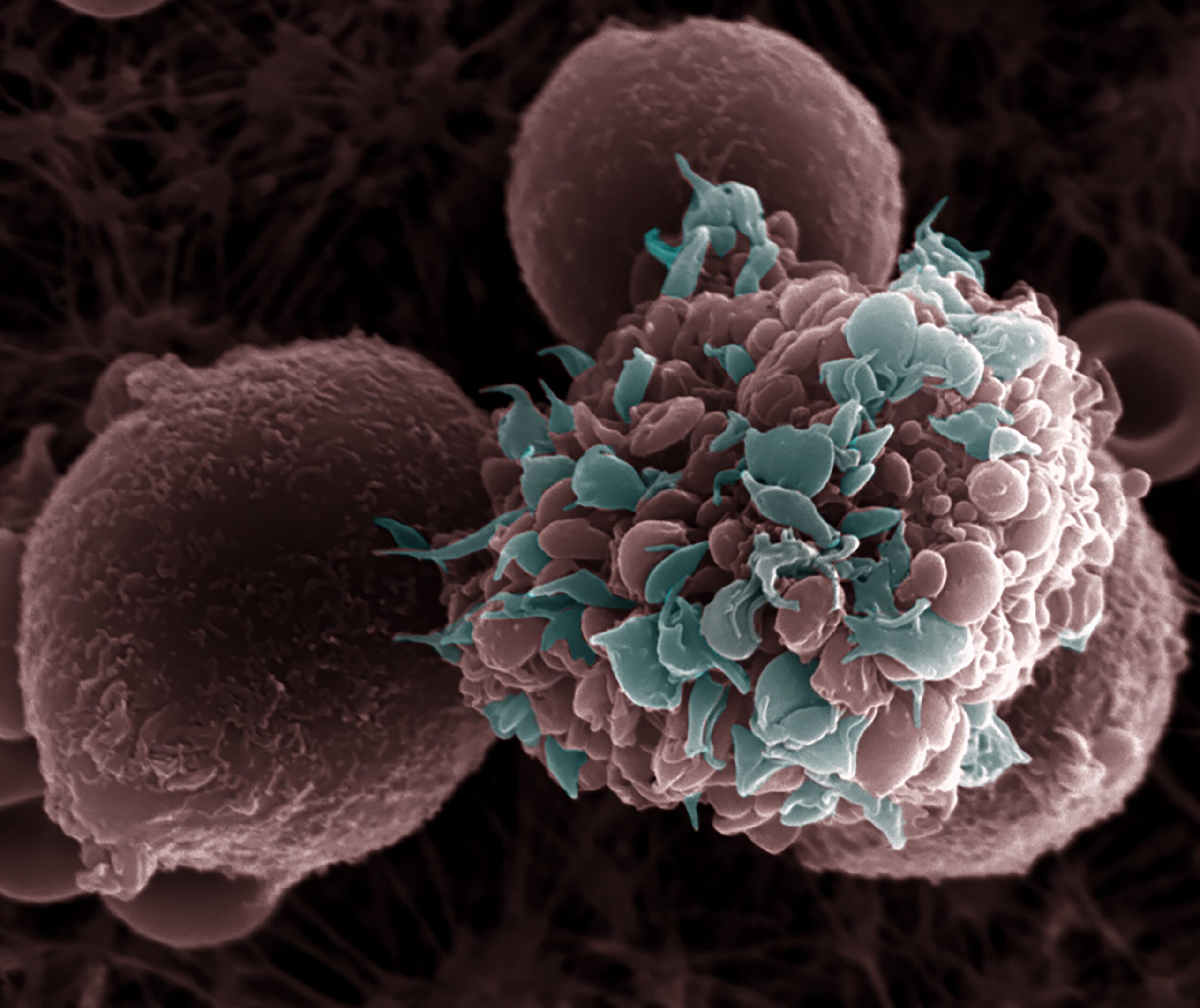 Le régime riche en graisses favorise les métastases du cancer du sein dans les modèles animaux